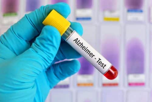 Quel test pour détecter la maladie d’Alzheimer ?